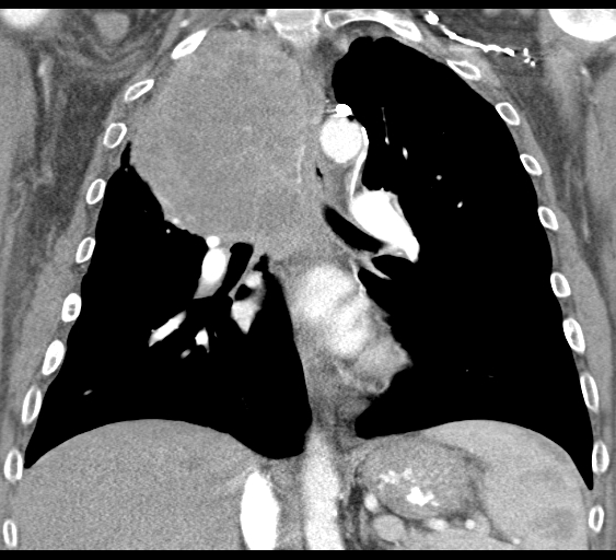 File:Obstructive superior vena cava tumor thrombus (Radiopaedia 28046-28306 B 28).jpg
