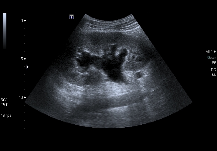 File:Obstructive uropathy and urolithiasis on ultrasound (Radiopaedia 25562-25758 A 1).jpg