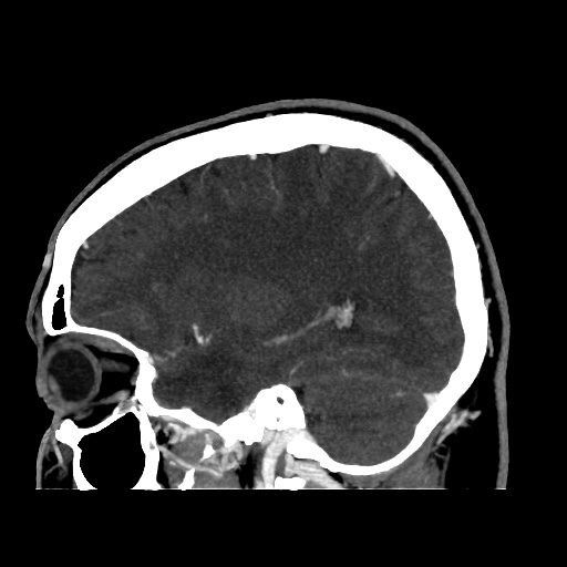 Occipital extradural hematoma simulating venous sinus thrombosis (Radiopaedia 46514-50964 D 54).jpg