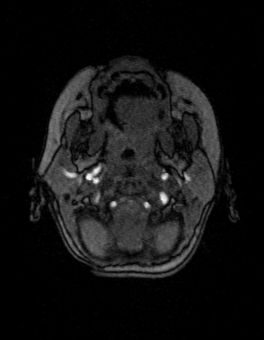 Occipital horn syndrome (Radiopaedia 14255-14129 MRA 11).jpg