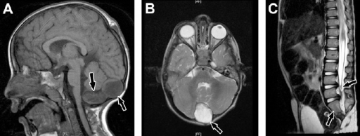 Caudal regression syndrome-a) Brain MRI shows 2 cystic structures at the region of cisterna magna b) cyst is also shown on axial T2-weighted image c) MRI dorsolumbar spine showing abrupt cutoff and bulbar configuration of conus medullaris at the level of L1