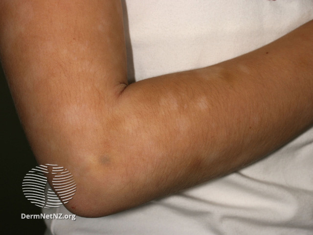 File:Pityrasis alba (DermNet NZ dermatitis-s-pityriasis-alba-3).jpg