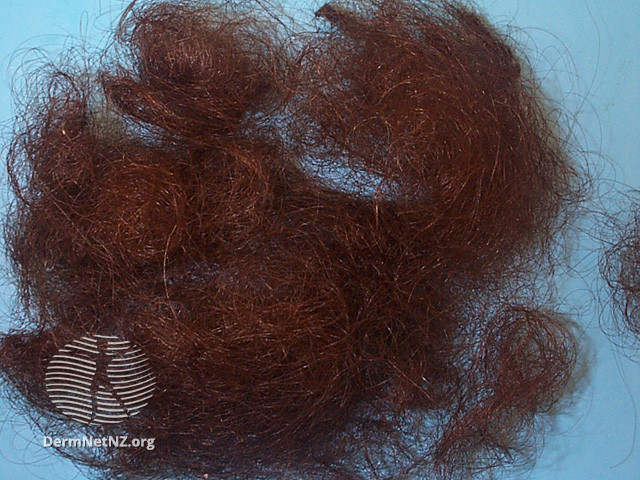 File:Telogen effluvium (DermNet NZ hair-nails-sweat-telogen-hair).jpg