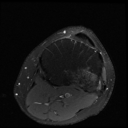 File:ACL and meniscal tears (Radiopaedia 79604-92797 Axial PD fat sat 20).jpg