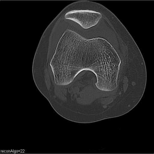 File:ACL avulsion fracture (Radiopaedia 33833-34994 Axial bone window 13).jpg