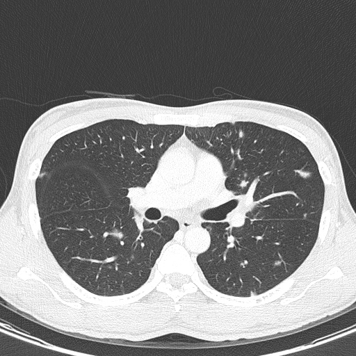 AIDS-related Kaposi sarcoma (Radiopaedia 85247-100811 Axial lung window 74).jpg