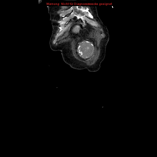 File:Abdominal aortic aneurysm- extremely large, ruptured (Radiopaedia 19882-19921 Coronal C+ arterial phase 7).jpg