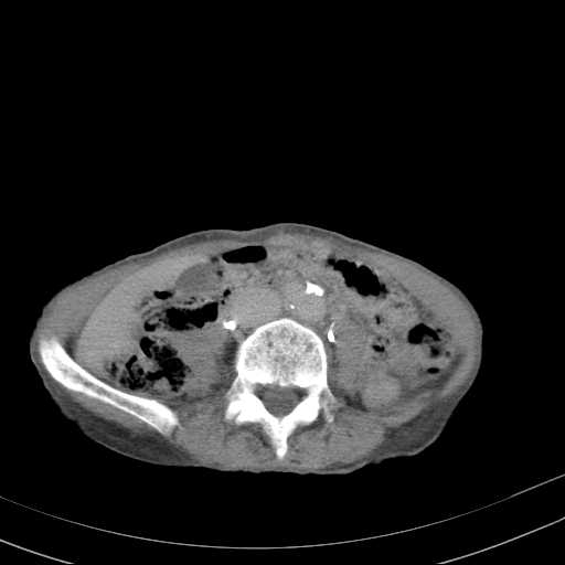 File:Abdominal aortic aneurysm (Radiopaedia 20827-20742 Axial C+ delayed 19).jpg