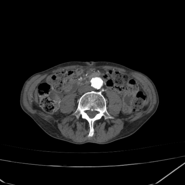 Abdominal aortic aneurysm (Radiopaedia 23703-23856 Axial C+ arterial phase 53).jpg