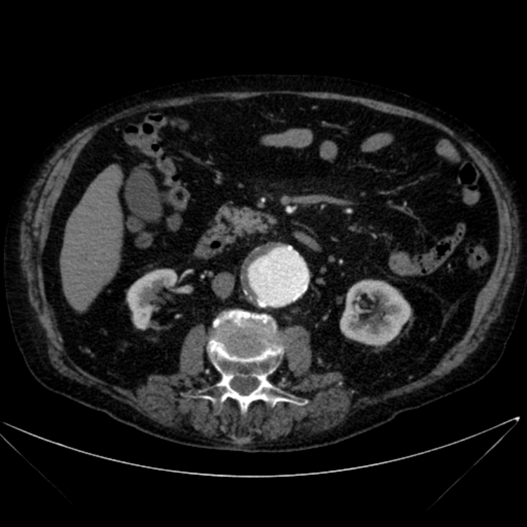 Abdominal aortic aneurysm (Radiopaedia 25855-26001 Axial C+ arterial phase 60).jpg
