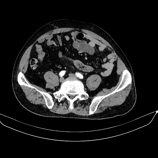 File:Abdominal aortic aneurysm (Radiopaedia 67117-76452 Axial C+ arterial phase 96).jpg