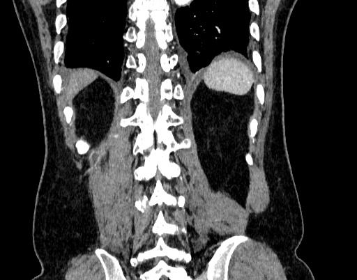 Abdominal aortic aneurysm (Radiopaedia 67117-76452 Coronal C+ arterial phase 93).jpg
