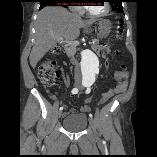 File:Abdominal aortic aneurysm (Radiopaedia 8190-9038 Coronal C+ arterial phase 55).jpg