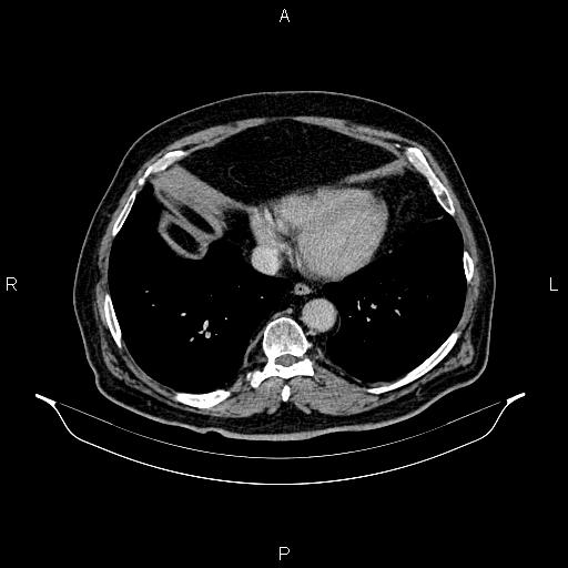 Abdominal aortic aneurysm (Radiopaedia 83094-97462 Axial renal excretory phase 9).jpg
