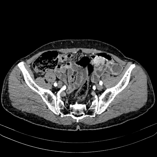 Abdominal aortic aneurysm (Radiopaedia 83581-98689 Axial C+ arterial phase 93).jpg