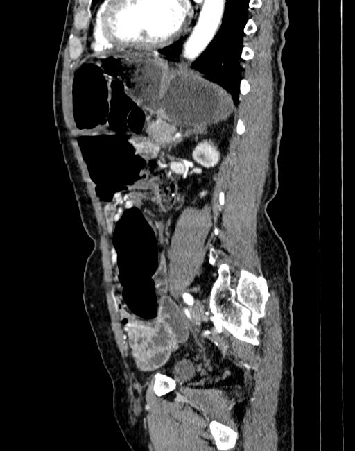 Abdominal aortic aneurysm (Radiopaedia 83581-98689 Sagittal C+ arterial phase 74).jpg
