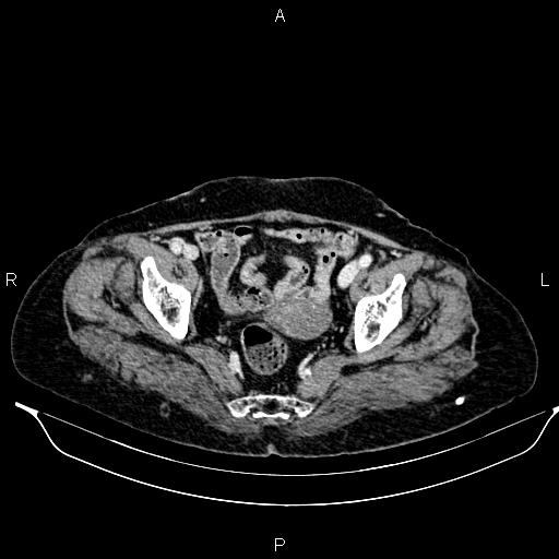 File:Abdominal aortic aneurysm (Radiopaedia 85063-100606 Axial C+ portal venous phase 60).jpg