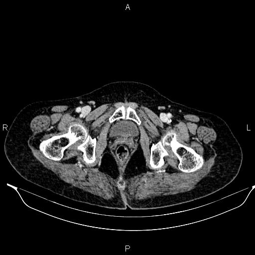 File:Abdominal aortic aneurysm (Radiopaedia 85063-100606 Axial C+ portal venous phase 66).jpg