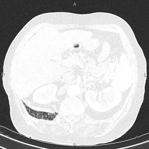 Abdominal aortic aneurysm (Radiopaedia 85063-100606 Axial lung window 65).jpg