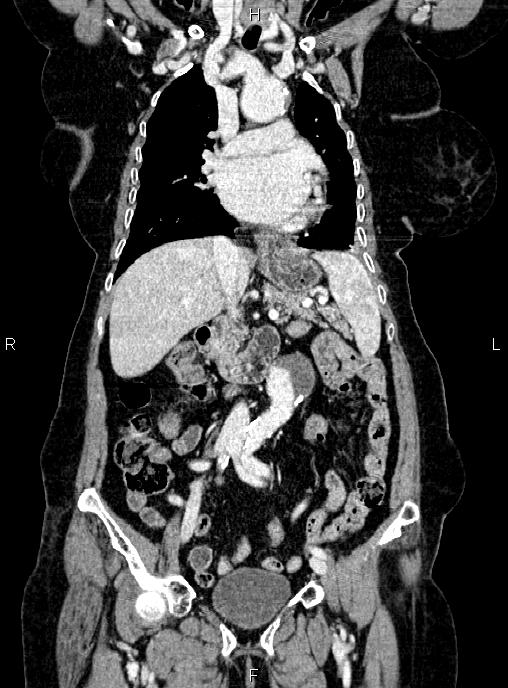 Abdominal aortic aneurysm (Radiopaedia 85063-100606 Coronal C+ arterial phase 24).jpg
