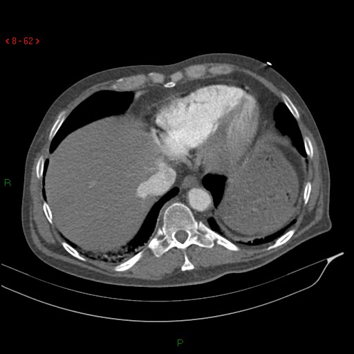 File:Abdominal aortic aneurysm rupture with aortocaval fistula (Radiopaedia 14897-14841 Axial C+ arterial phase 62).jpg