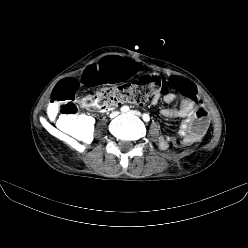 File:Abdominal collection due to previous cecal perforation (Radiopaedia 80831-94320 Axial C+ portal venous phase 124).jpg