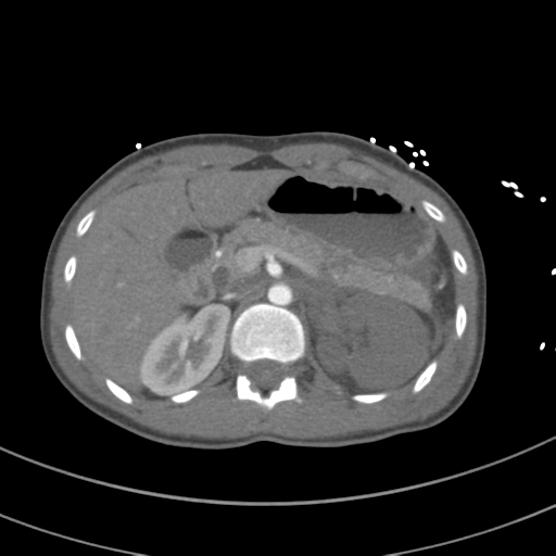 File:Abdominal multi-trauma - devascularised kidney and liver, spleen and pancreatic lacerations (Radiopaedia 34984-36486 Axial C+ arterial phase 98).png
