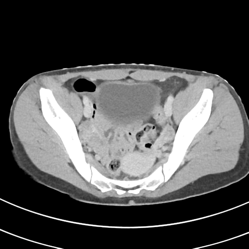 File:Abdominal multi-trauma - devascularised kidney and liver, spleen and pancreatic lacerations (Radiopaedia 34984-36486 Axial C+ delayed 67).png