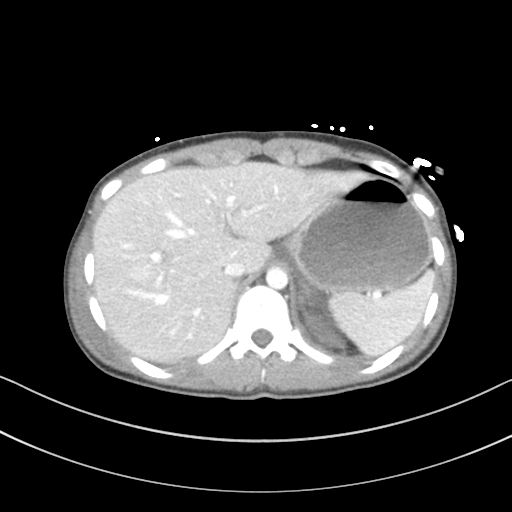 Abdominal multi-trauma - devascularised kidney and liver, spleen and pancreatic lacerations (Radiopaedia 34984-36486 Axial C+ portal venous phase 15).png