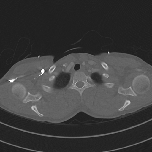 File:Abdominal multi-trauma - devascularised kidney and liver, spleen and pancreatic lacerations (Radiopaedia 34984-36486 I 12).png