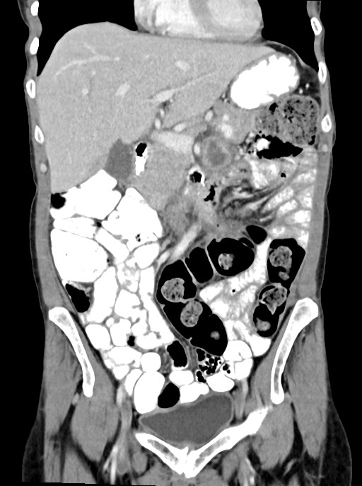 Abdominal wall and retroperitoneal tuberculosis (Radiopaedia 88137-104729 Coronal C+ portal venous phase 39).jpg