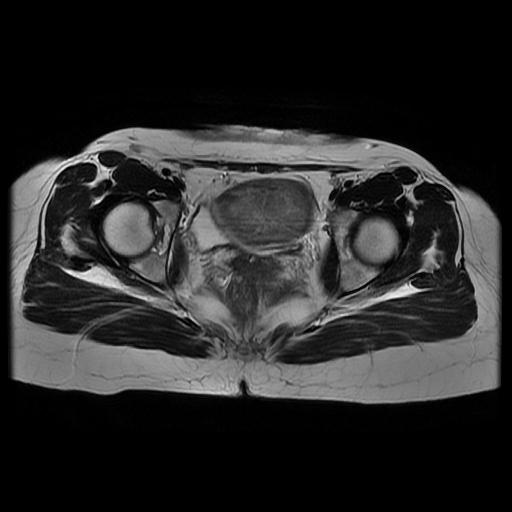 File:Abdominal wall endometriosis (Radiopaedia 83702-98847 Axial T2 13).jpg