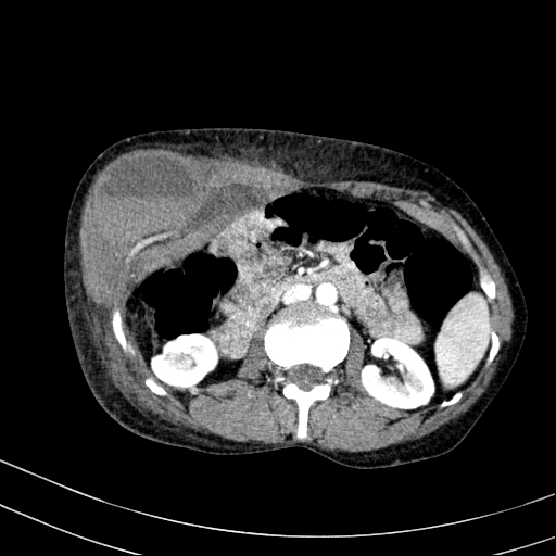 Abdominal wall hematoma with active bleeding (Radiopaedia 83915-99117 Axial renal cortical phase 31).jpg