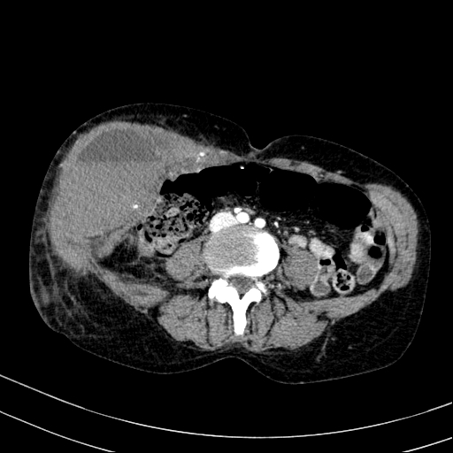 Abdominal wall hematoma with active bleeding (Radiopaedia 83915-99117 Axial renal cortical phase 66).jpg