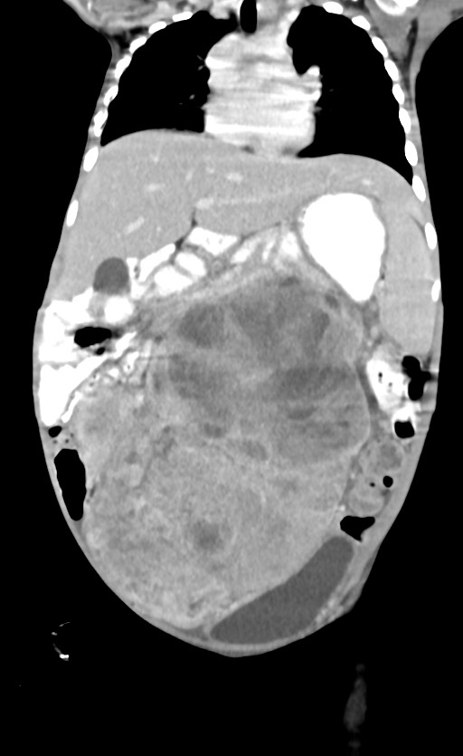 Abdominopelvic rhabdomyosarcoma (Radiopaedia 78356-90984 Coronal C+ portal venous phase 40).jpg