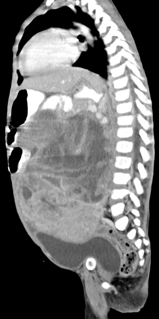 Abdominopelvic rhabdomyosarcoma (Radiopaedia 78356-90984 Sagittal C+ portal venous phase 40).jpg