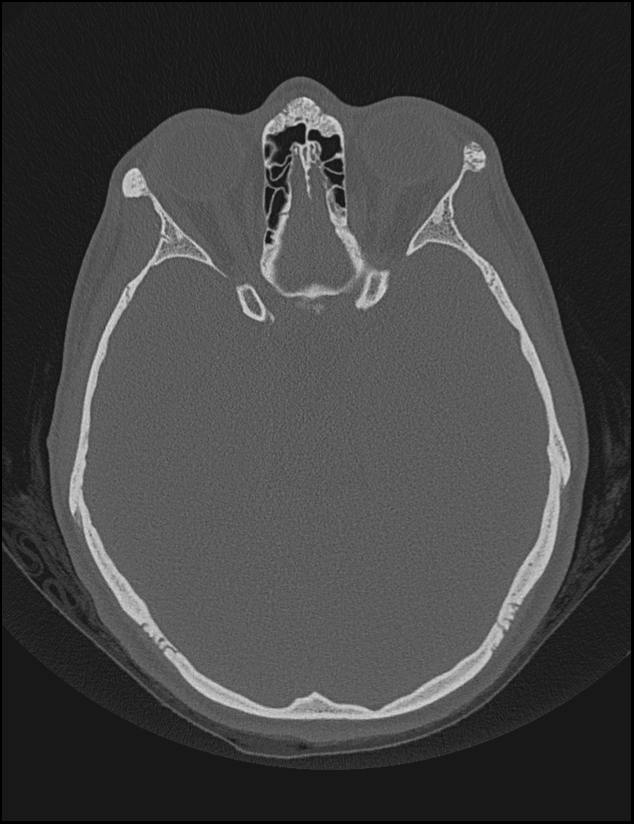 Aberrant right internal carotid artery (Radiopaedia 65191-74198 Axial non-contrast 74).jpg
