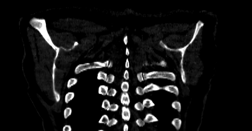 Accesory rib joint (Radiopaedia 71987-82452 Coronal bone window 79).jpg