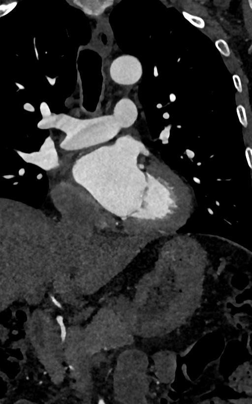 Accessory left atrial appendage (Radiopaedia 81987-95968 Coronal C+ arterial phase 70).jpg