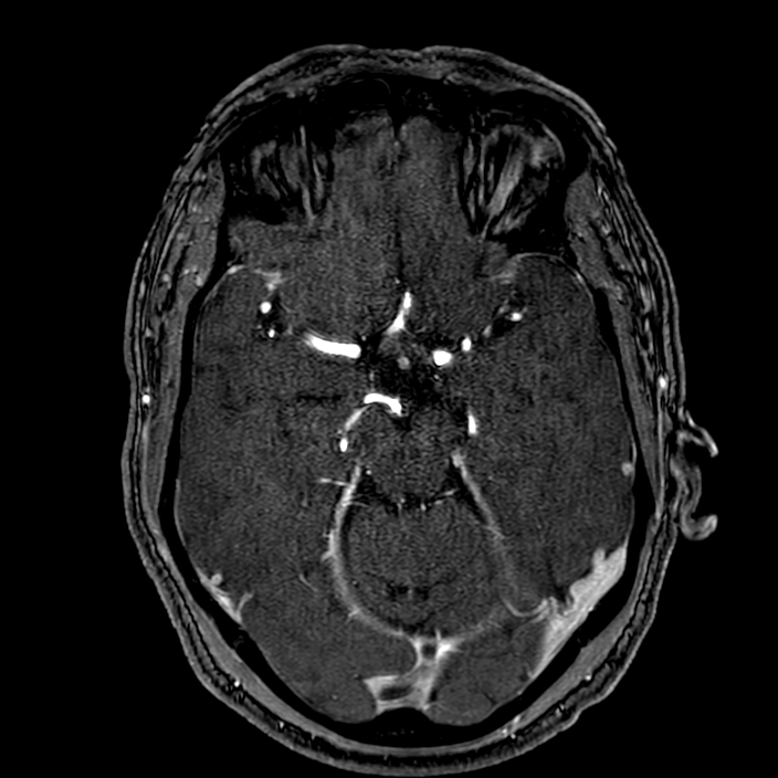 Accessory middle cerebral artery (Radiopaedia 73114-83828 Axial MRA 71).jpg