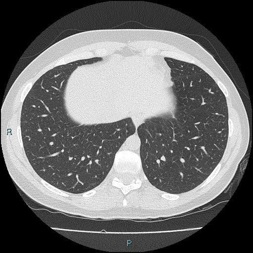 File:Accidental foreign body aspiration (seamstress needle) (Radiopaedia 77740-89983 Axial lung window 52).jpg