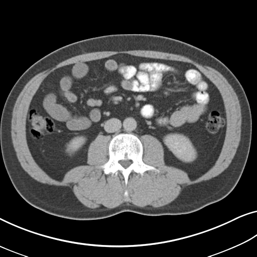 Achalasia of the cardia (Radiopaedia 38497-40595 Axial C+ portal venous phase 45).png