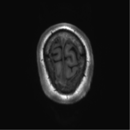 File:Achondroplasia (Radiopaedia 65109-74105 Axial T1 4).png