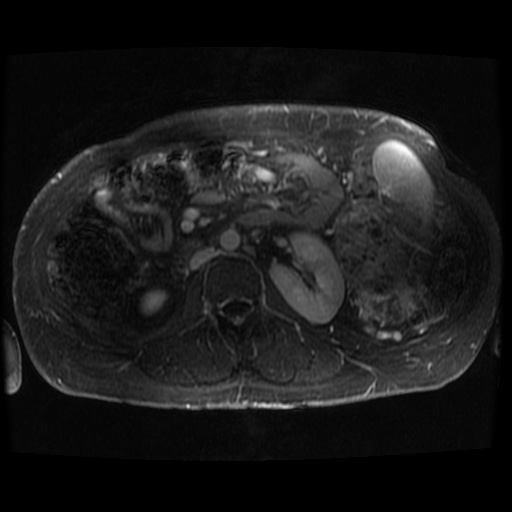 File:Acinar cell carcinoma of the pancreas (Radiopaedia 75442-86668 Axial T1 C+ fat sat 22).jpg