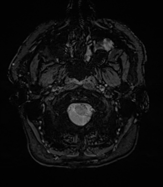 Acoustic schwannoma (Radiopaedia 50846-56358 Axial SWI 5).png