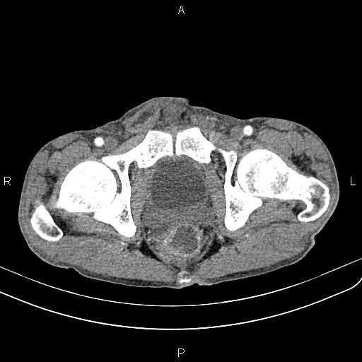 Active crohn disease (Radiopaedia 87133-103397 Axial C+ arterial phase 101).jpg