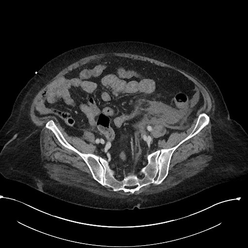File:Active renal extravasation with large subcapsular and retroperitoneal hemorrhage (Radiopaedia 60975-68796 Axial 266).jpg