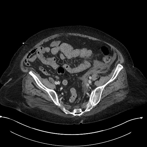 File:Active renal extravasation with large subcapsular and retroperitoneal hemorrhage (Radiopaedia 60975-68796 Axial 274).jpg