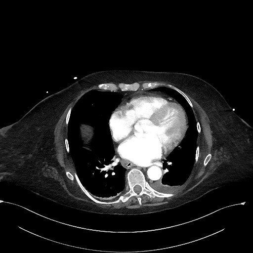 Active renal extravasation with large subcapsular and retroperitoneal hemorrhage (Radiopaedia 60975-68796 Axial C+ arterial phase 7).jpg