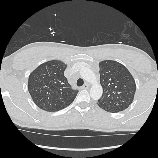 File:Active right ventricular cardiac sarcoidosis (Radiopaedia 55596-62101 Axial lung window 8).jpg
